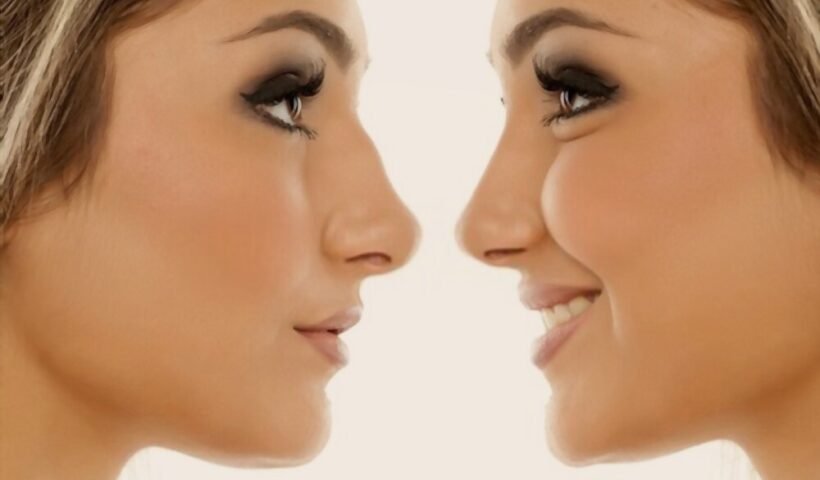 Non-surgical rhinoplasty