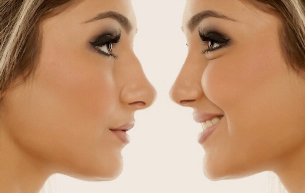 Non-surgical rhinoplasty